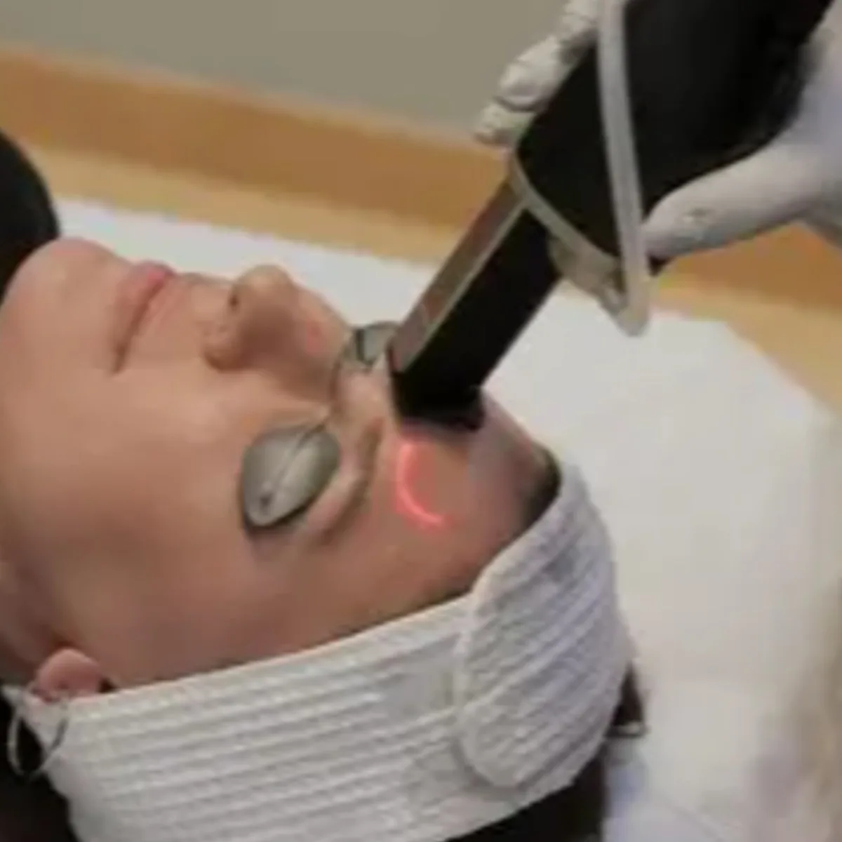 Before Laser Hair Removal