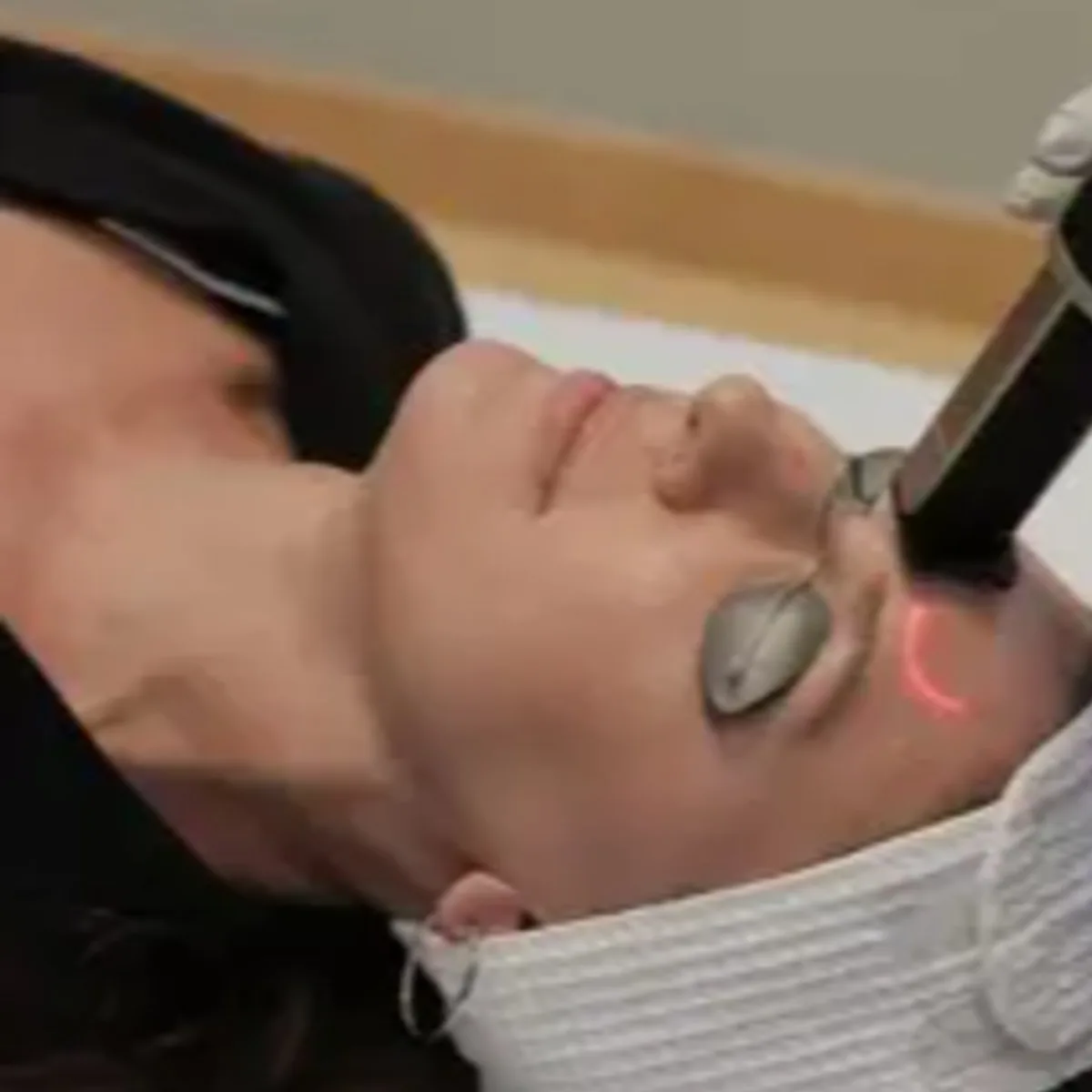 Laser Hair Removal Results